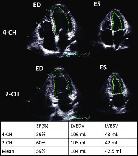 Automated assessment of left ventricle ejection fraction and volumes.... | Download Scientific ...