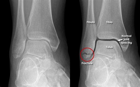 Trauma X-ray - Lower limb gallery 2 - Ankle - Malleolar fractures