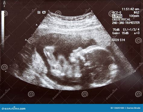 Ultrasound During Second Trimester Stock Photo - Image of sonar ...