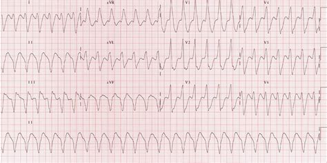 Ventricular Tachycardia – Core EM