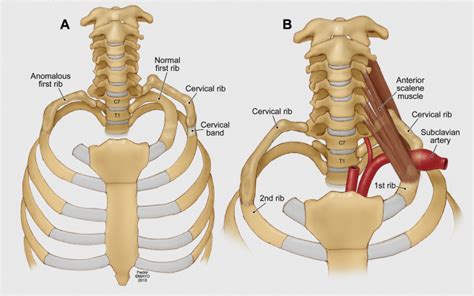 Cervical rib - Tom Quick