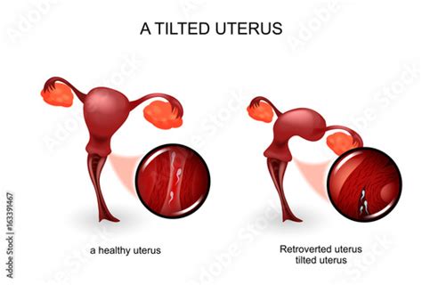 "a tilted uterus. gynecology" Stock image and royalty-free vector files on Fotolia.com - Pic ...