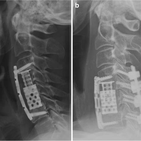 Two-level cervical corpectomy—long-term follow-up reveals the high rate ...