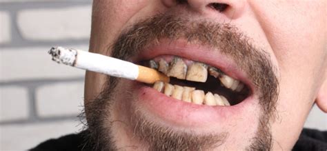 How To Remove Tobacco Stains From Your Teeth - Teeth Poster