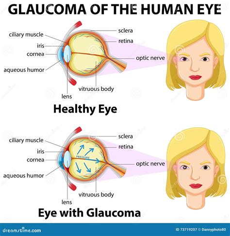 Glaucoma of the human eye stock vector. Illustration of woman - 73719207