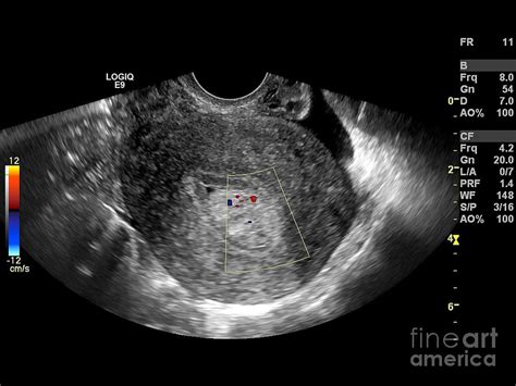 Endometrial Polyp