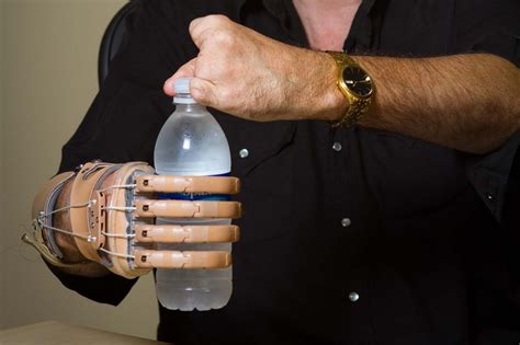 Body-powered partial hand prosthesis in 2021 | Prosthetics, Hands, Partial