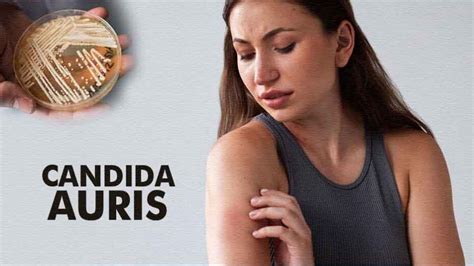 Candida Auris Treatment: Causes, Symptoms And Testing