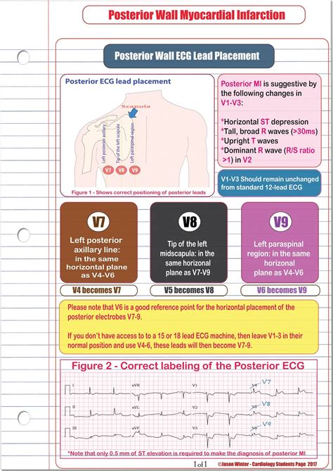 ECG Educator Blog : Posterior ECG Lead Placement