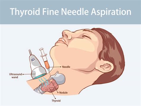 Fine Needle Biopsy Illustrations, Royalty-Free Vector Graphics & Clip Art - iStock