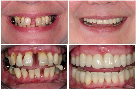 Treatment for Periodontal Disease | Advanced Dentistry