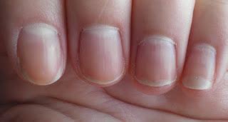 Liver disease fingernails - Awesome Nail