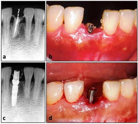 Immediate implant placement in the right lower central incisor (#41)... | Download Scientific ...