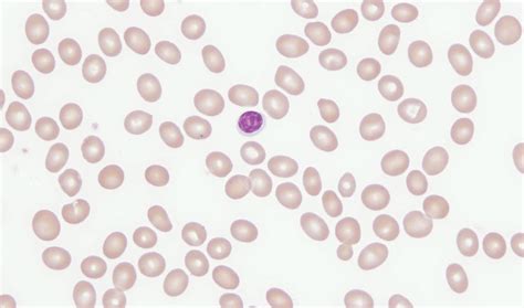 Macrocytic Anemia - Causes, Symptoms & Macrocytic Anemia Treatment