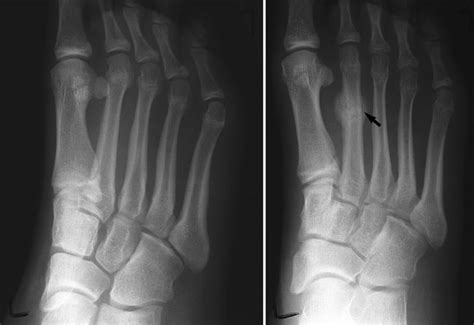 What Are Stress Fractures Of The Feet? - Sutherland Podiatry Sutherland Podiatry