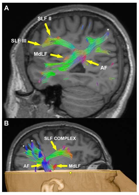 Angular Gyrus Mri