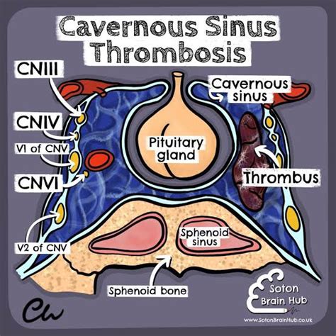 Cavernous Sinus Thrombosis : r/neurology