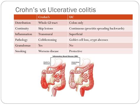 Ulcerative Colitis Causes Symptoms Diagnosis And Treatment