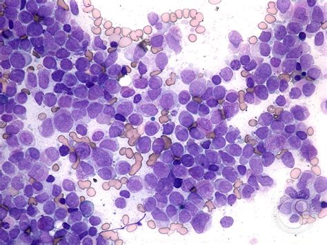 Acute promyelocytic leukemia - 1.