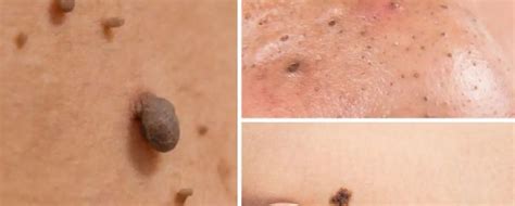 Mole and Skin Tag Removal Options Beverly Hills | Los Angeles CA Med Spa