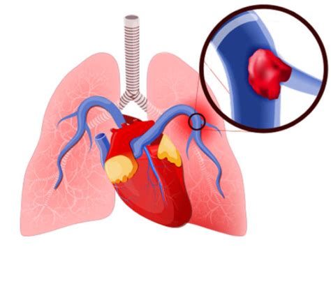 pulmonary embolism signs | Dr Raghu