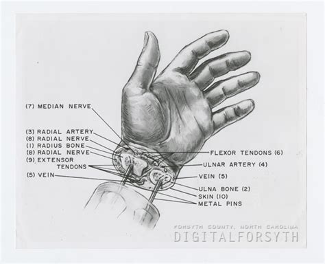 Digital Forsyth | Hand Re-Implantation