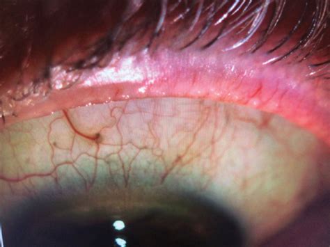 Meibomian Gland Disease