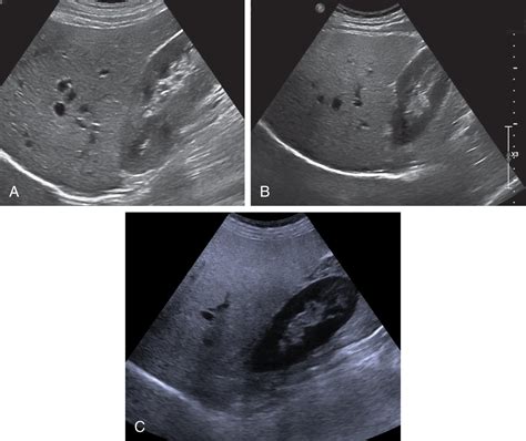 Conventional ultrasound findings in chronic liver disease | Radiology Key