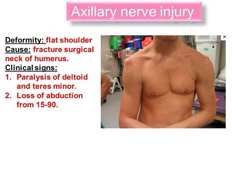 Axillary nerve injury (F.R) ... Note: Axillary nerve supplies Deltoid ...