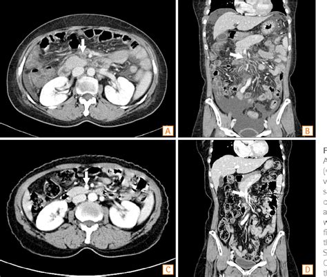 Figure 1 from Superior Mesenteric Vein Thrombosis as an Early Presentation of Myelodysplastic ...