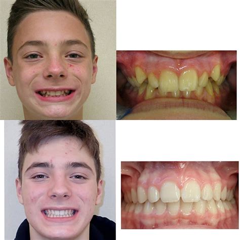 Before & After Braces | Wazio Orthodontics