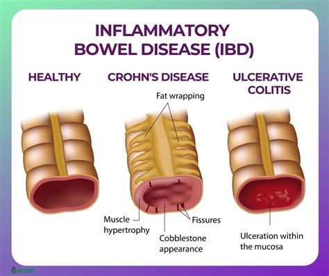 ULCERATIVE COLITIS (UC) - Symptoms, Causes, Risk Factors, Ulcerative Colitis Diet, Lifestyle ...