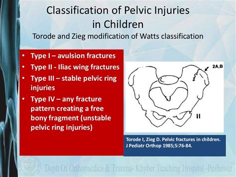 Pelvic fracture classification