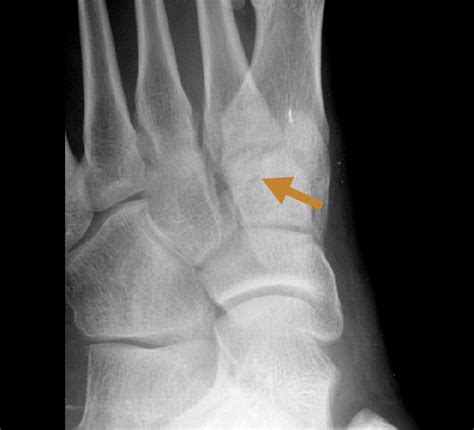 Cuneiform Bone Fracture