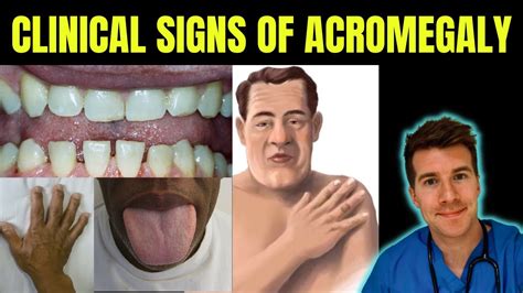 Doctor explains signs & symptoms of Acromegaly (gigantism) including prognathism, frontal ...