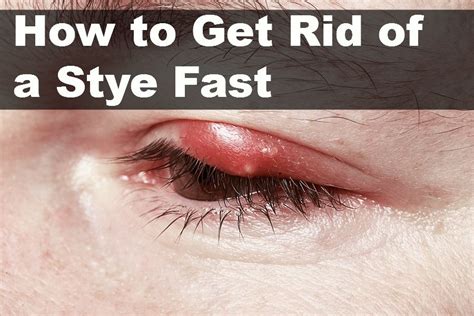 How to Get Rid of a Stye Fast | Vital Home Remedies | Eye stye remedies, Stye treatment, Skin