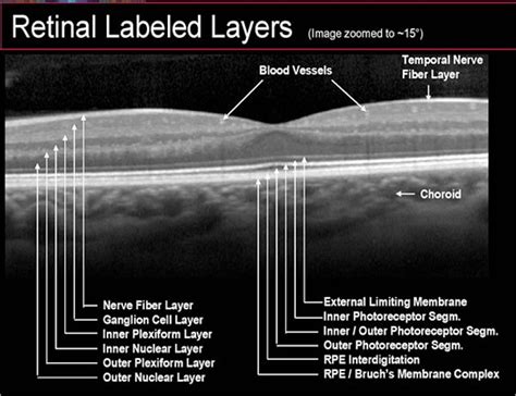 OPTICAL COHERENCE TOMOGRAPHY (OCT) - Toronto Eye Clinic