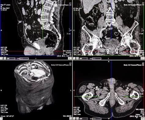 What Does a CT Scan Show