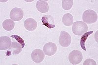 Plasmodium falciparum, blood smear with more gametocytes * – Instruments Direct