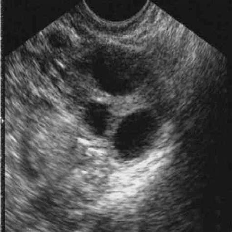 Healthy Ovarian Ultrasound