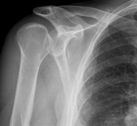 Shoulder Dislocation X Ray