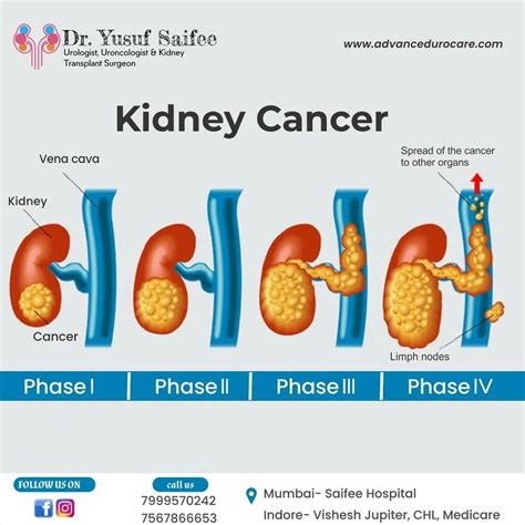 Kidney Cancer Treatment in Mumbai, Kidney Cancer Doctor in… | Flickr