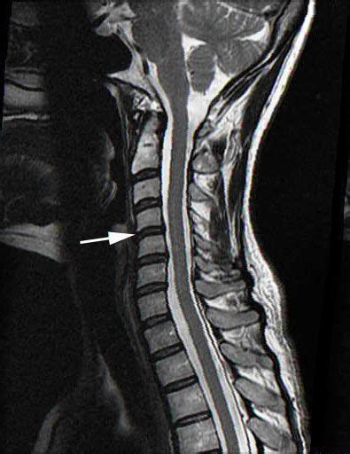 normal cervical spine mri | Mri scan, Mri