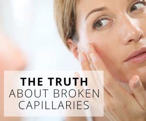 What causes broken facial capillaries? Real Facts