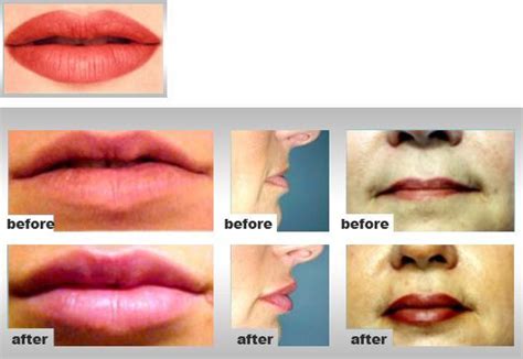 stomion images – Recherche Google in 2020 | Lip augmentation, Lip ...