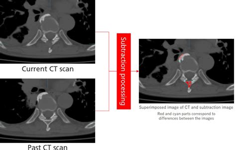 Technology supporting early detection of bone metastasis | Canon Global