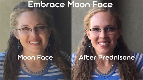 Embrace Moon Face - Dr. Megan Side Effects & Solutions