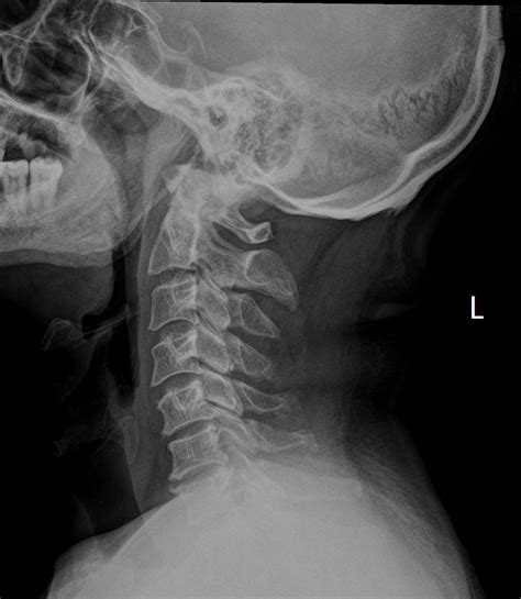 Cervical Spondylosis X Ray Findings