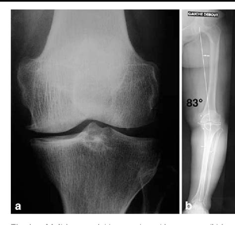 distal femoral osteotomy | Semantic Scholar