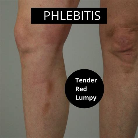 What Does Phlebitis of the Leg Look Like | with Pictures? | The ...